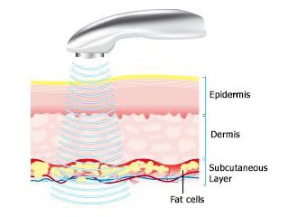 Illustration of a handheld device sending ultrasound waves through the epidermis and dermis into the subcutaneous layer